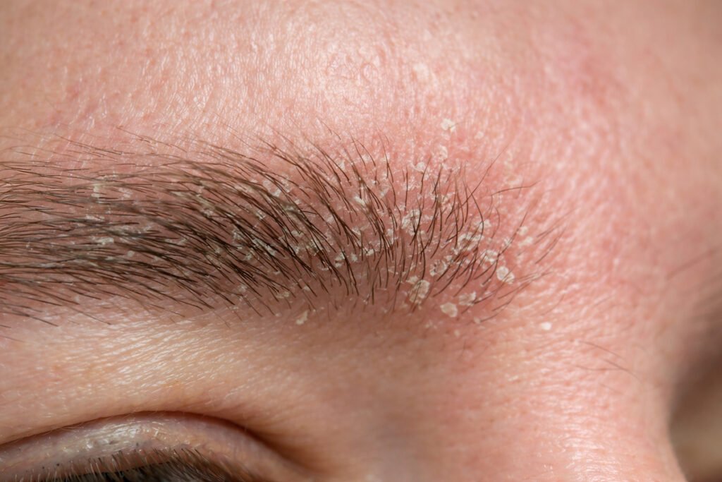 Dermatitis Seborreica