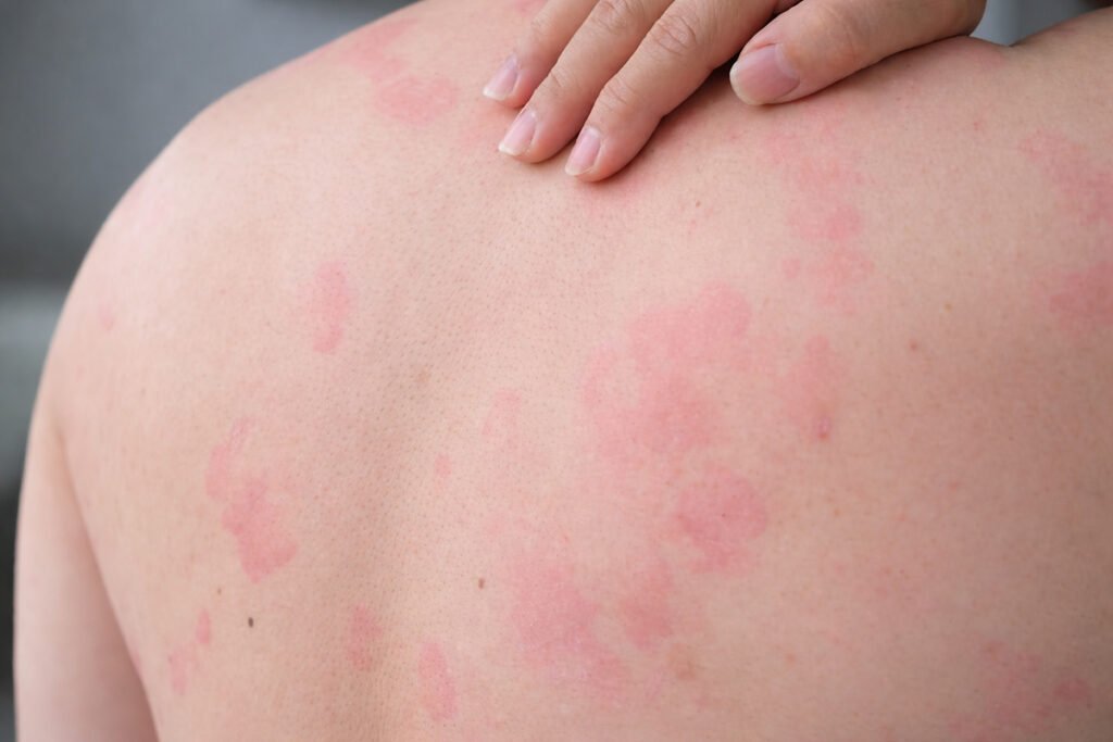 Urticaria