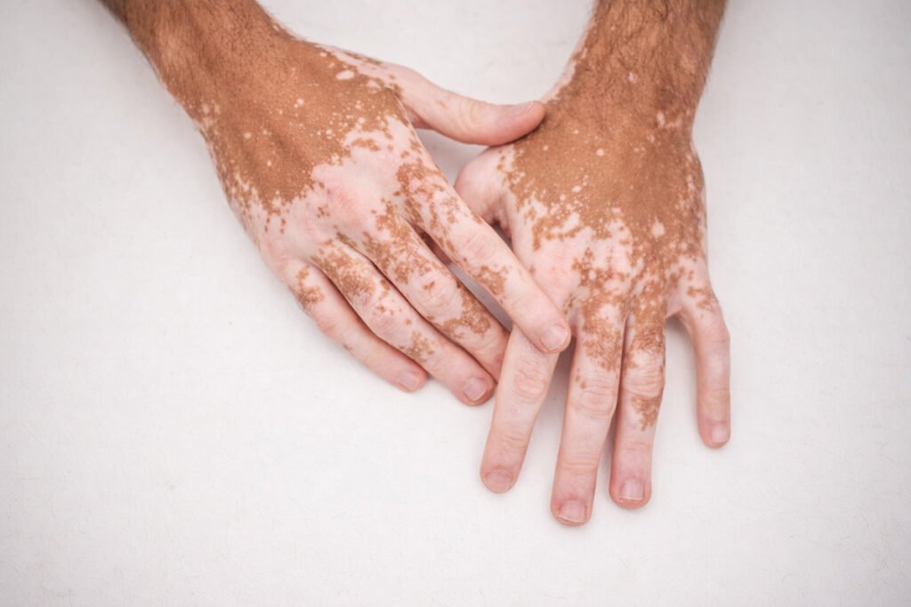 Vitiligo